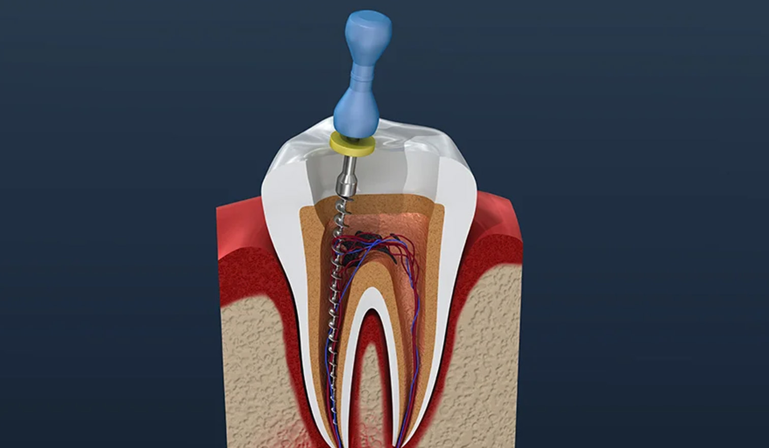 初めて歯の神経（歯髄）の治療をすることになったら