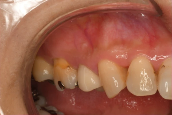 case1 After