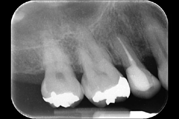 case1 After