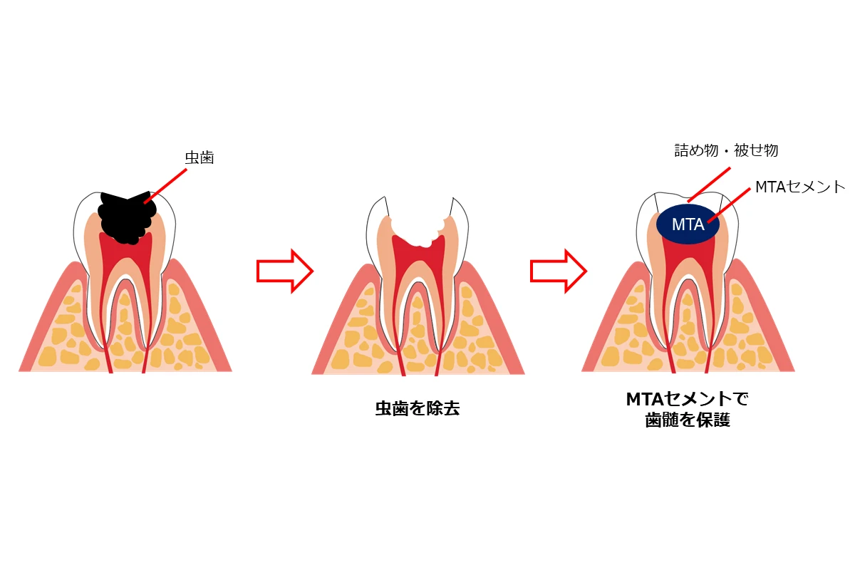 歯髄保存治療について