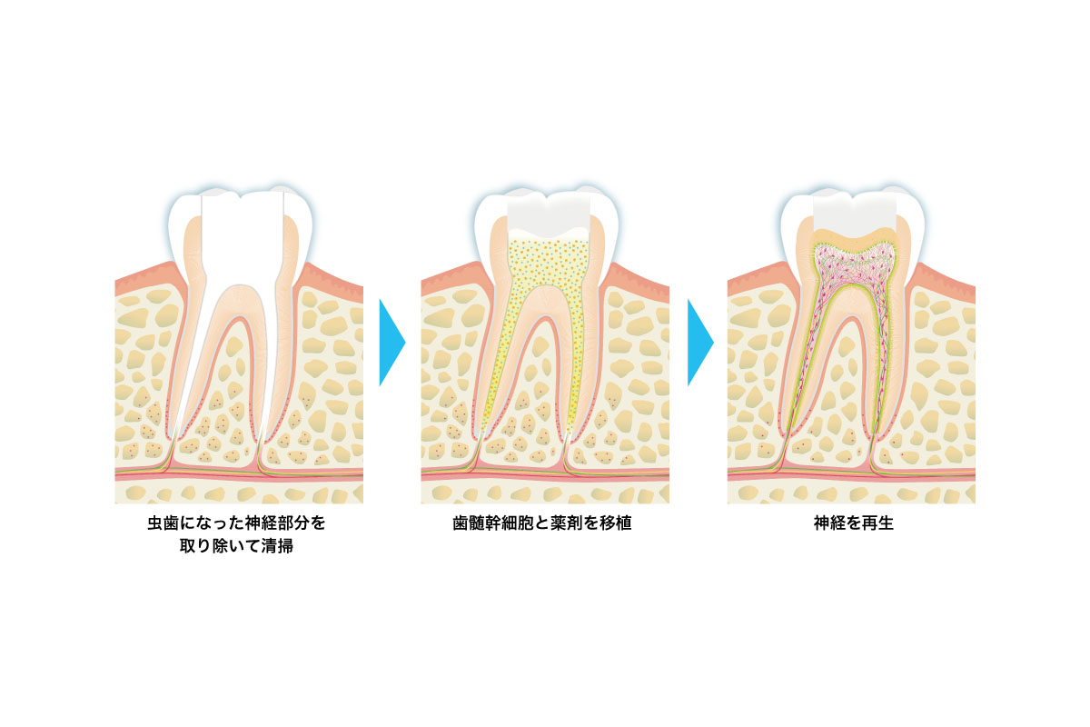 歯髄再生治療について