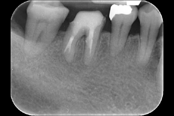 case2 After