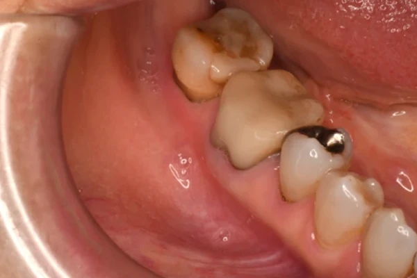 case2 Before