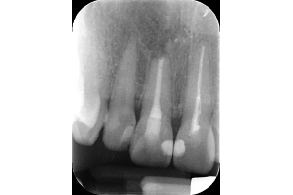 case3 After